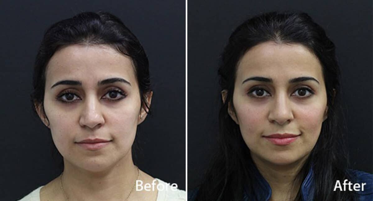 Facelift Before and After Photos in Princeton, NJ, Patient 267