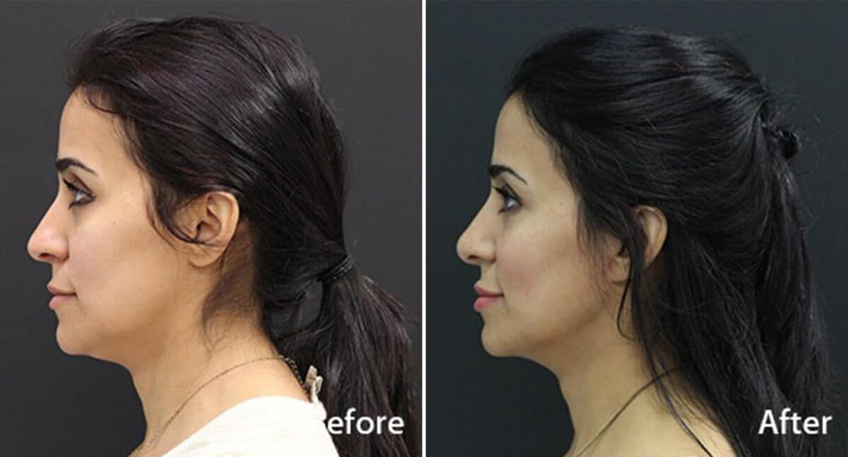 Facelift Before and After Photos in Princeton, NJ, Patient 267