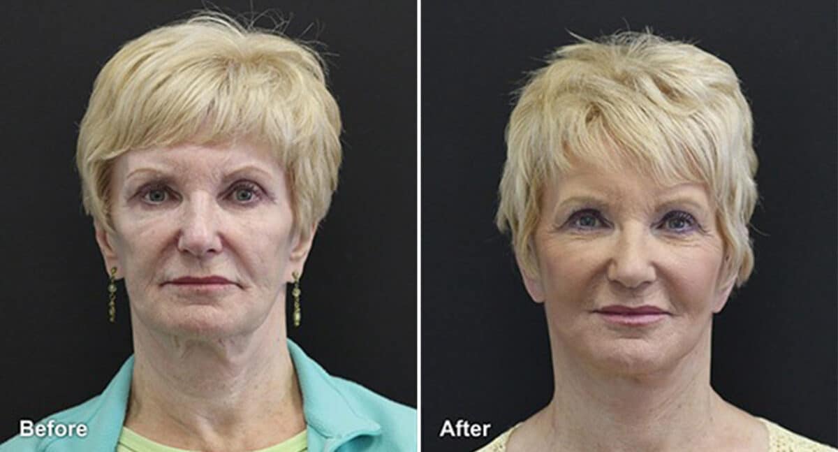 Facelift Before and After Photos in Princeton, NJ, Patient 277