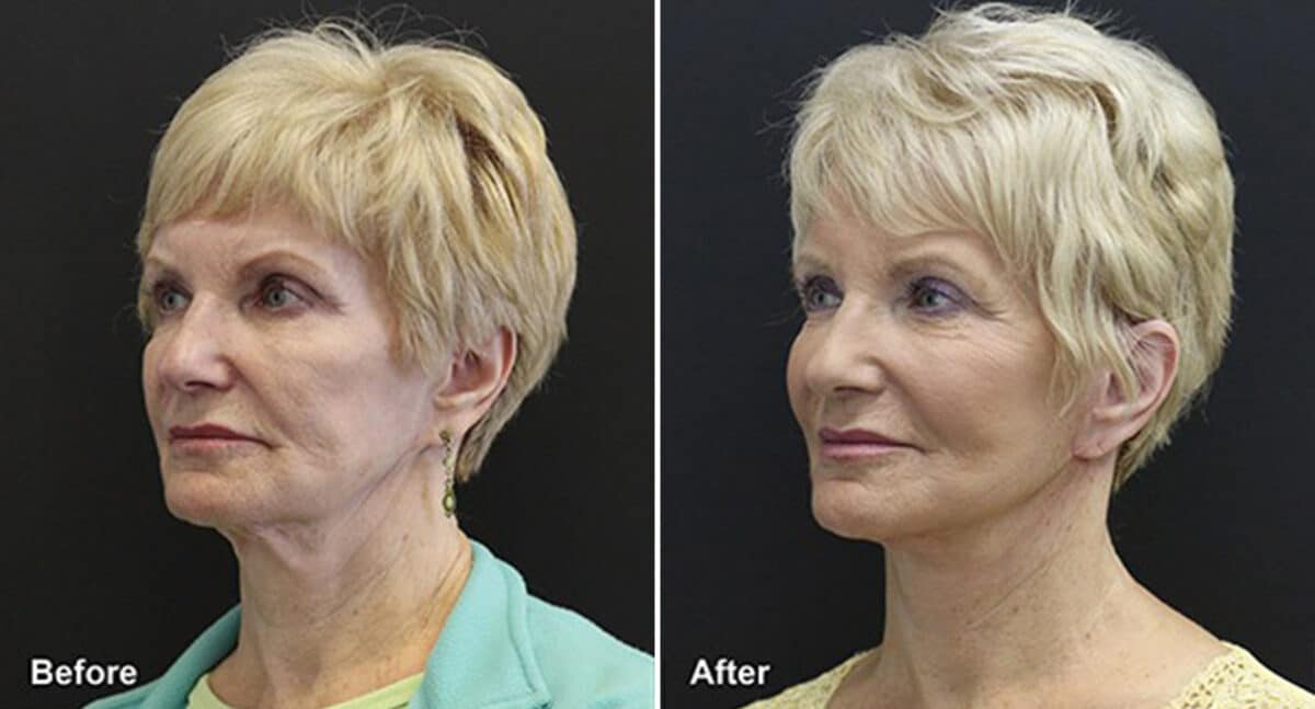 Facelift Before and After Photos in Princeton, NJ, Patient 277