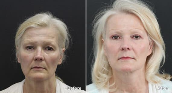 Facelift Before and After Photos in Princeton, NJ, Patient 284