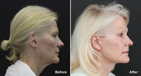 Facelift Before and After Photos in Princeton, NJ, Patient 284