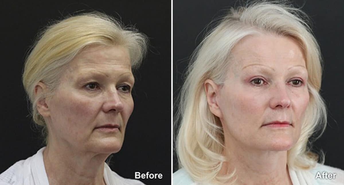 Facelift Before and After Photos in Princeton, NJ, Patient 284