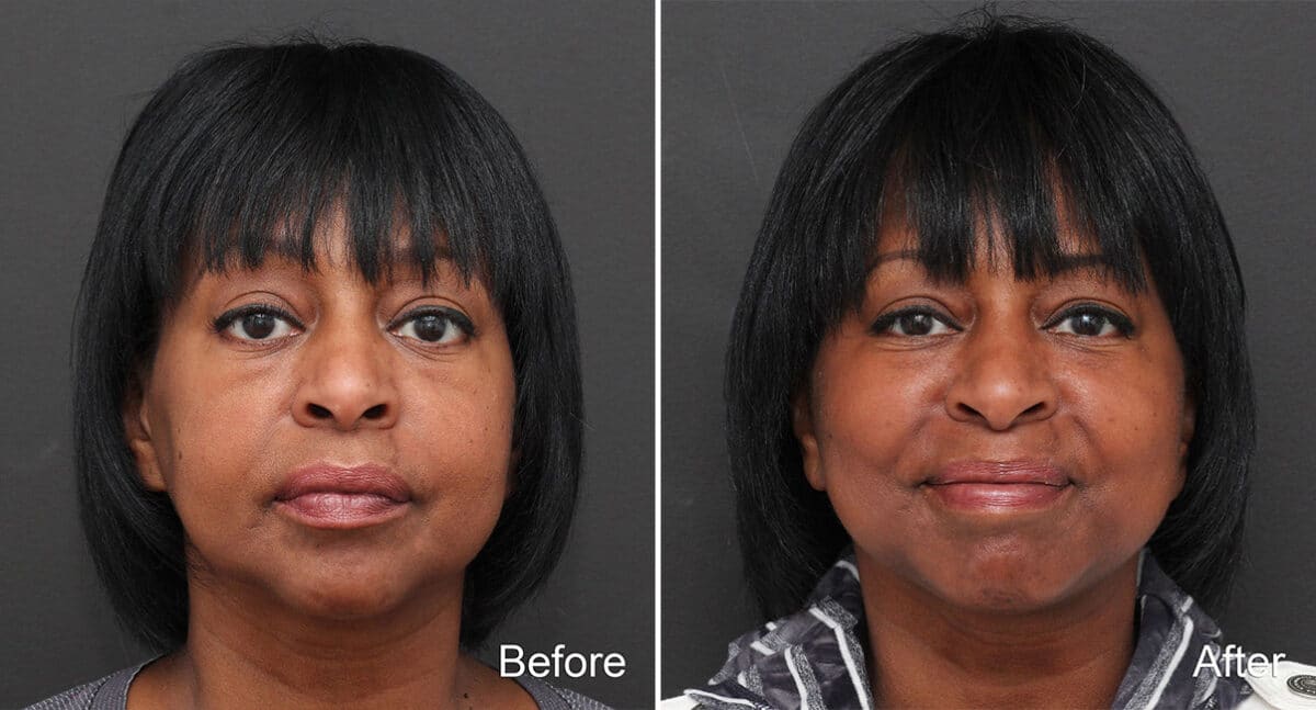 Facelift Before and After Photos in Princeton, NJ, Patient 294