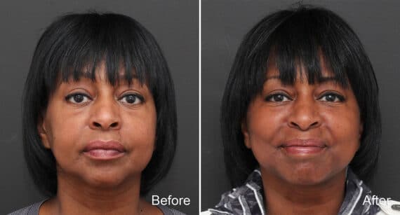 Facelift Before and After Photos in Princeton, NJ, Patient 294