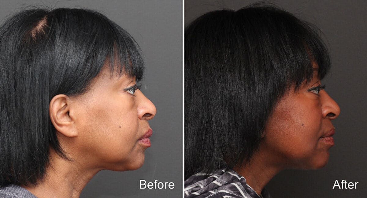 Facelift Before and After Photos in Princeton, NJ, Patient 294