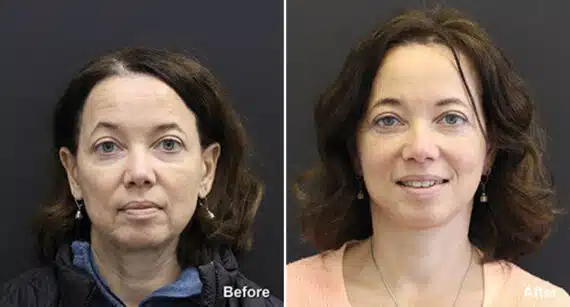 Facelift Before and After Photos in Princeton, NJ, Patient 185