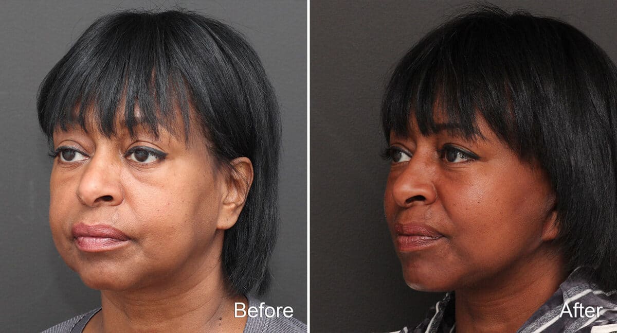 Facelift Before and After Photos in Princeton, NJ, Patient 294