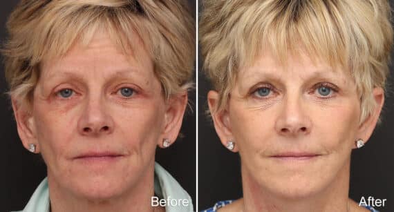 Facelift Before and After Photos in Princeton, NJ, Patient 304