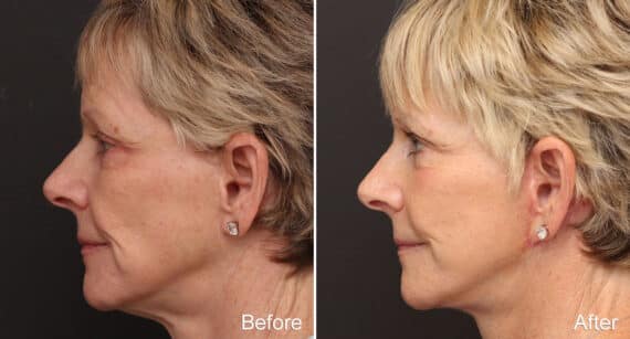 Facelift Before and After Photos in Princeton, NJ, Patient 304