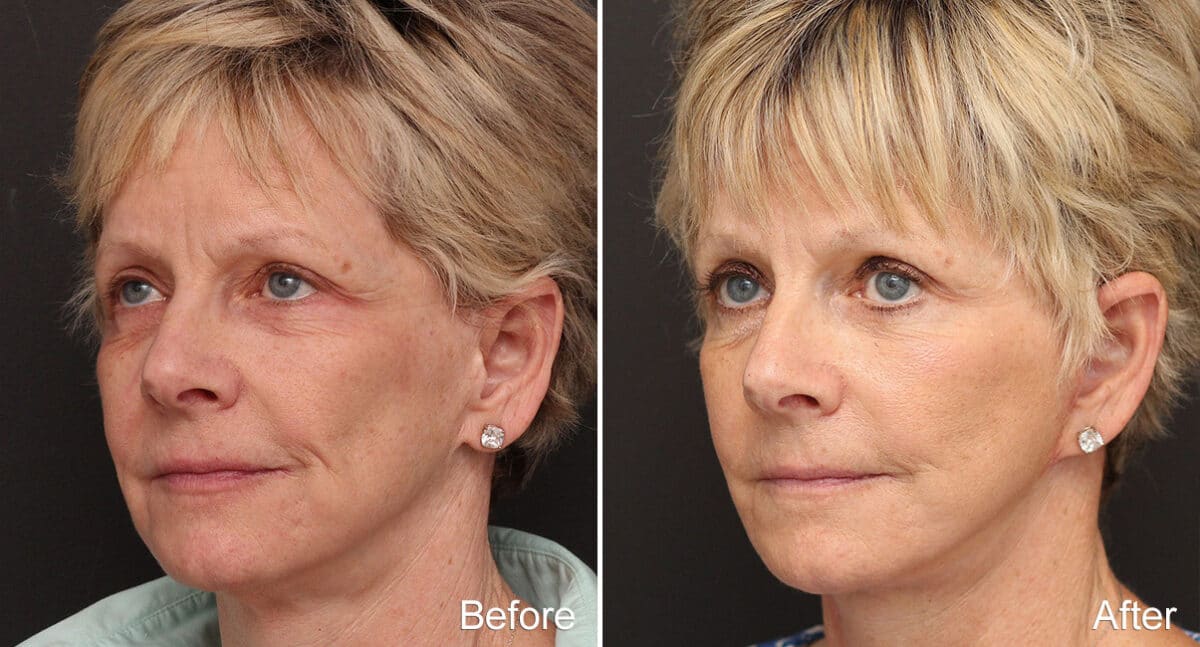 Facelift Before and After Photos in Princeton, NJ, Patient 304