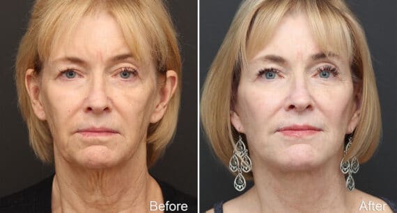 Facelift Before and After Photos in Princeton, NJ, Patient 314