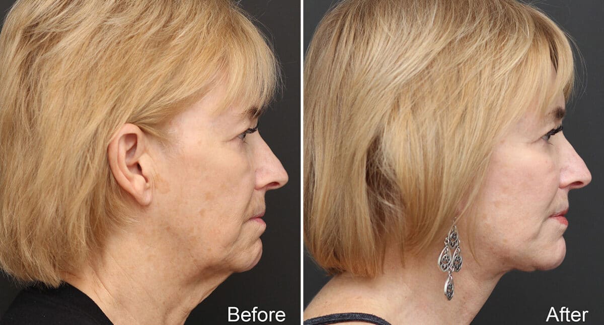 Facelift Before and After Photos in Princeton, NJ, Patient 314