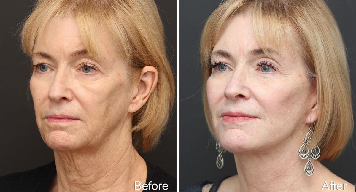 Facelift Before and After Photos in Princeton, NJ, Patient 314