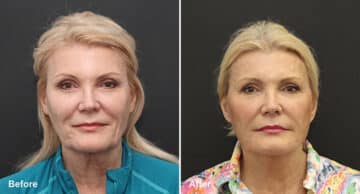 Facelift Before and After Photos in Princeton, NJ, Patient 324