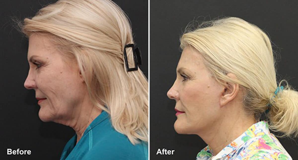 Facelift Before and After Photos in Princeton, NJ, Patient 324