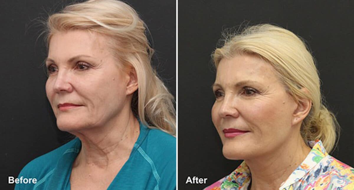 Facelift Before and After Photos in Princeton, NJ, Patient 324