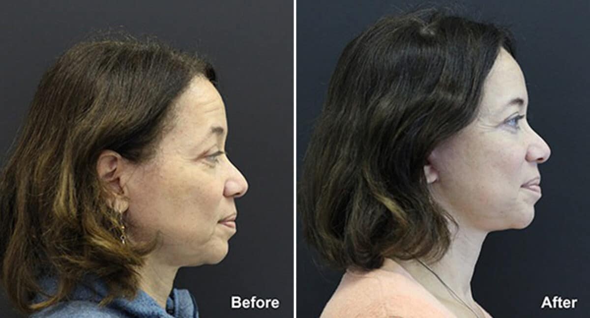 Facelift Before and After Photos in Princeton, NJ, Patient 185