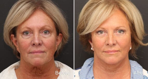 Facelift Before and After Photos in Princeton, NJ, Patient 334