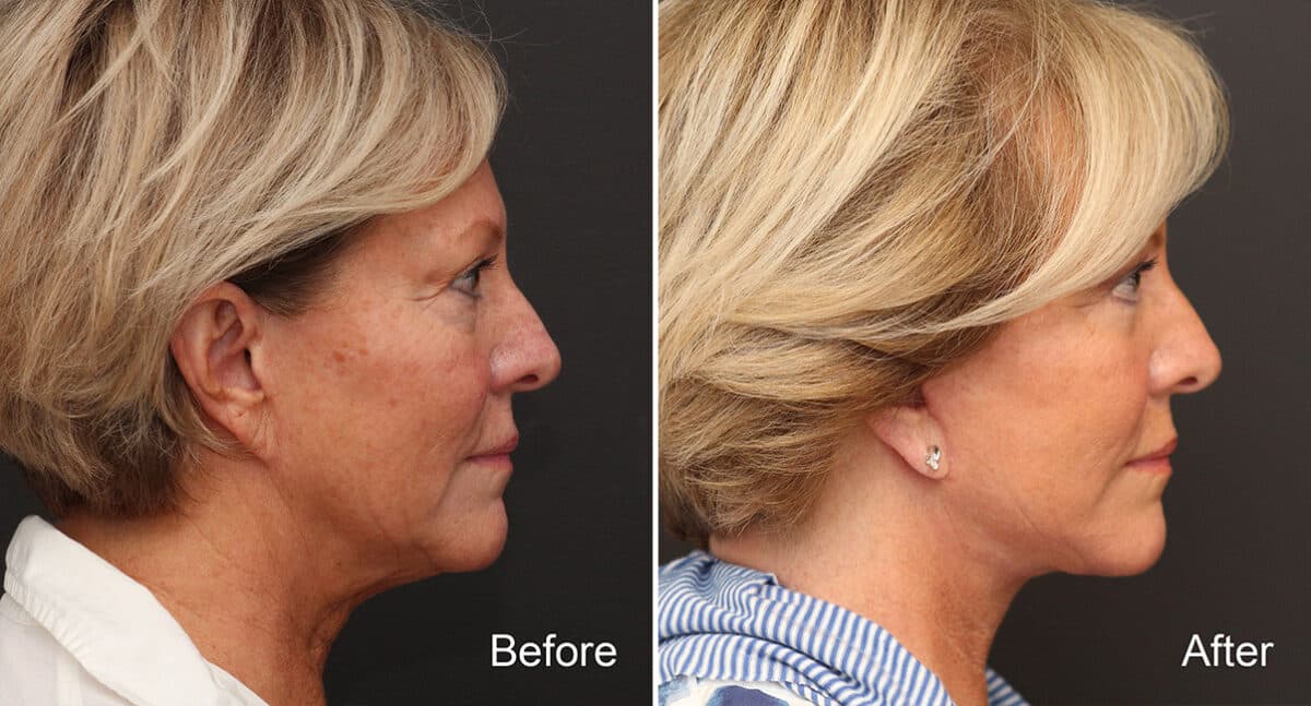 Facelift Before and After Photos in Princeton, NJ, Patient 334