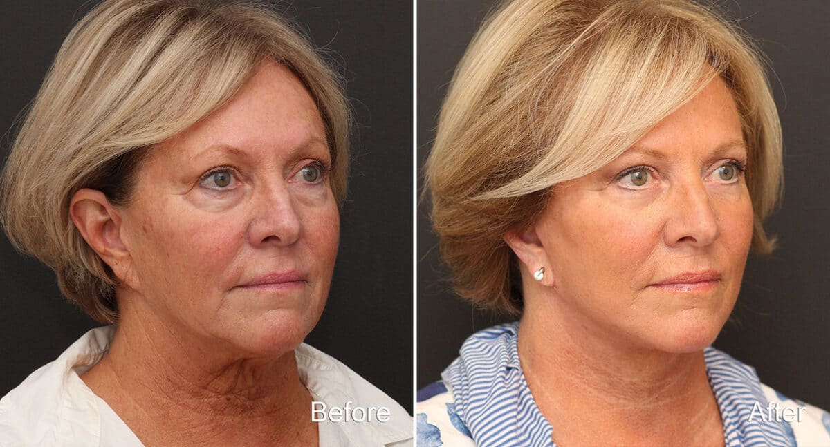 Facelift Before and After Photos in Princeton, NJ, Patient 334