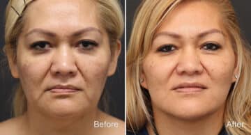 Facelift Before and After Photos in Princeton, NJ, Patient 344