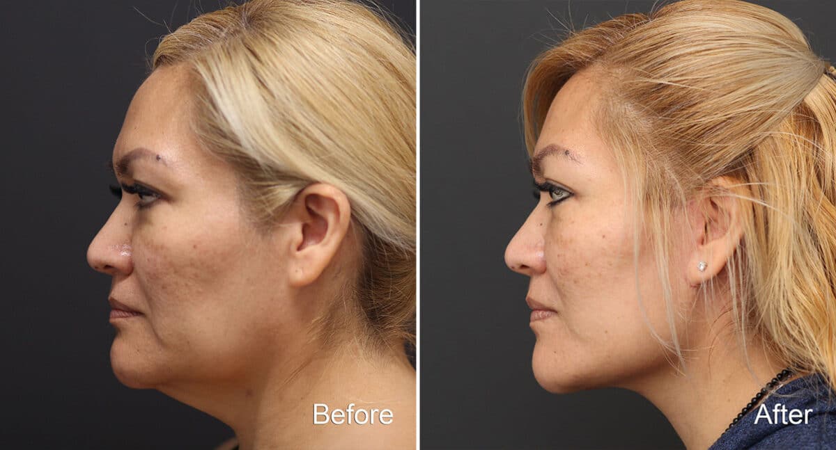 Facelift Before and After Photos in Princeton, NJ, Patient 344