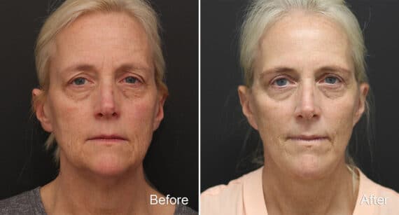 Facelift Before and After Photos in Princeton, NJ, Patient 354