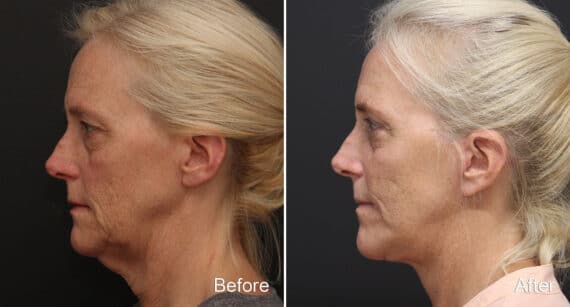 Facelift Before and After Photos in Princeton, NJ, Patient 354