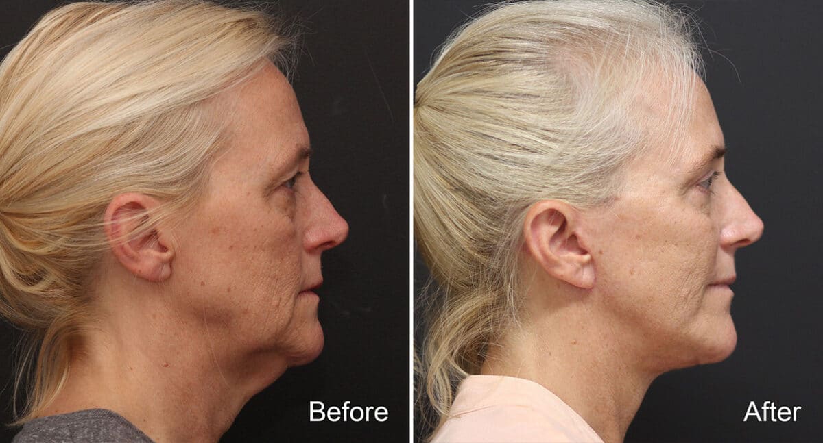 Facelift Before and After Photos in Princeton, NJ, Patient 354