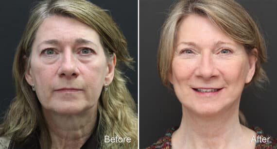 Facelift Before and After Photos in Princeton, NJ, Patient 364