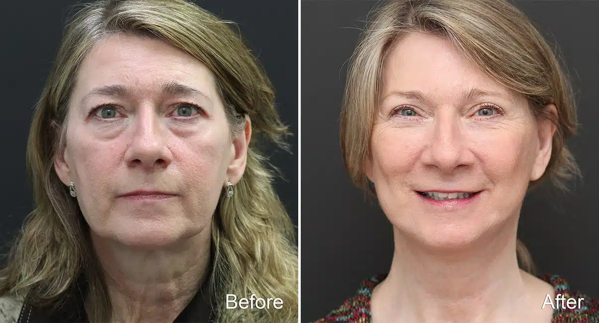 Blepharoplasty Before & After photos