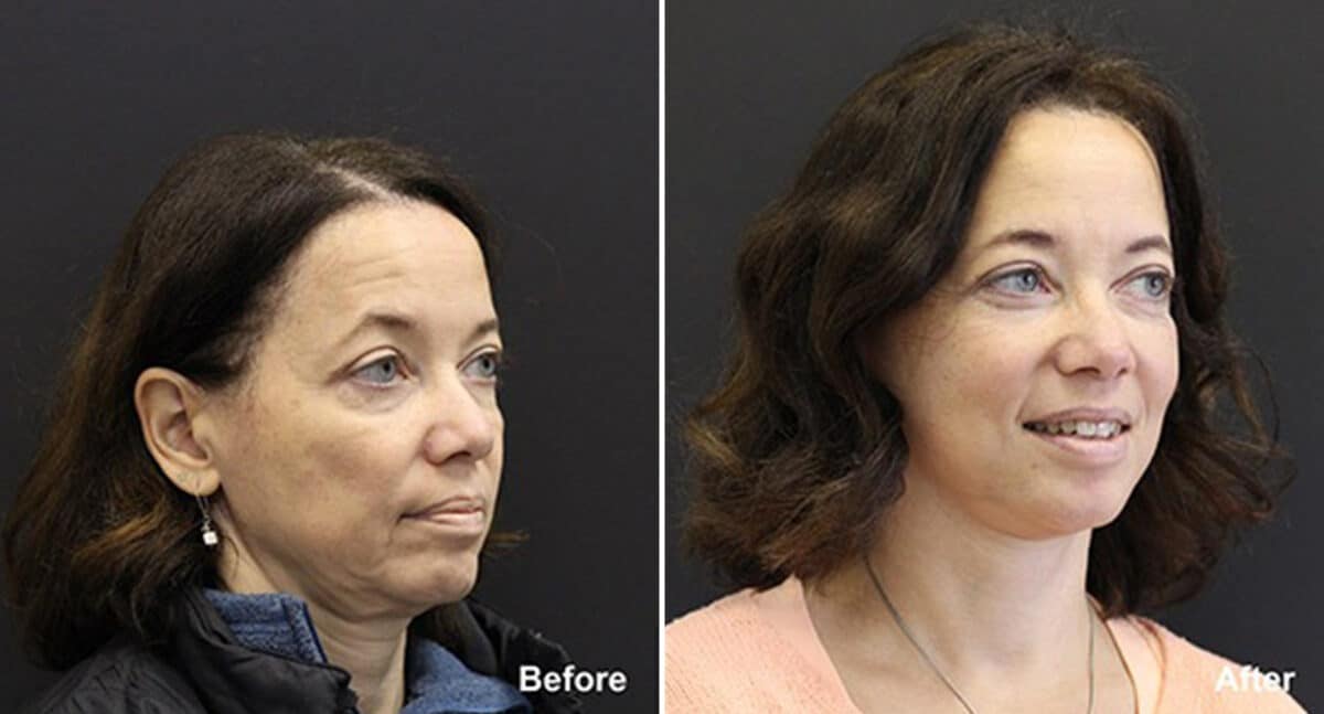 Facelift Before and After Photos in Princeton, NJ, Patient 185