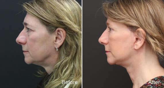 Facelift Before and After Photos in Princeton, NJ, Patient 364