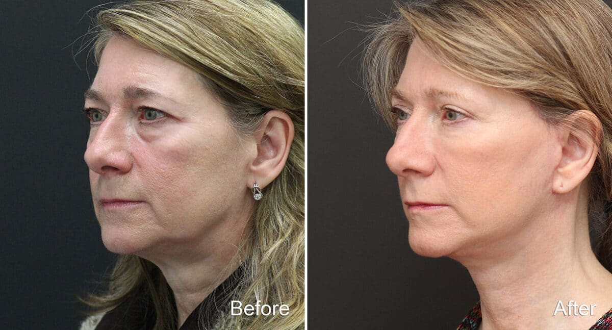 Facelift Before and After Photos in Princeton, NJ, Patient 364