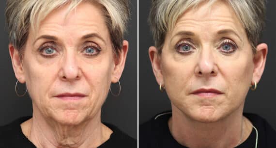 Facelift Before and After Photos in Princeton, NJ, Patient 374