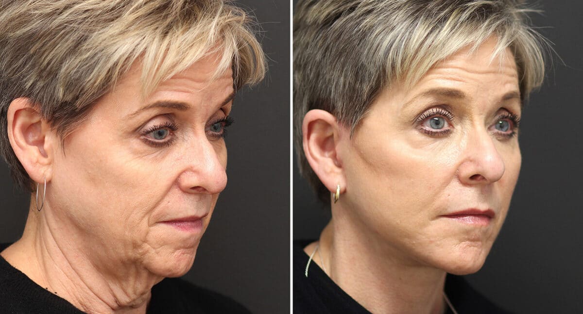 Facelift Before and After Photos in Princeton, NJ, Patient 374