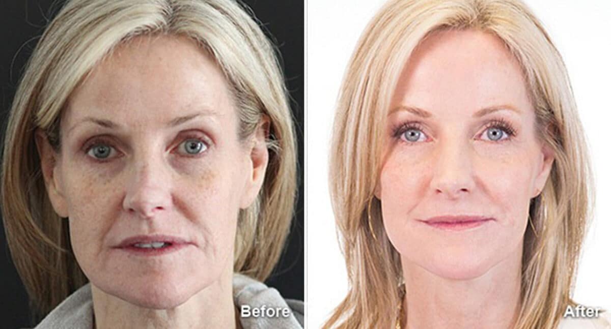 Facelift Before and After Photos in Princeton, NJ, Patient 190