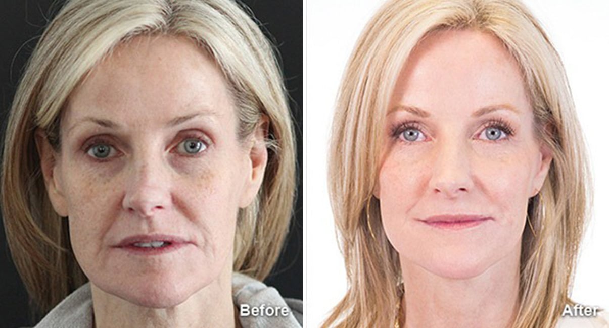 Facelift Before & After photos