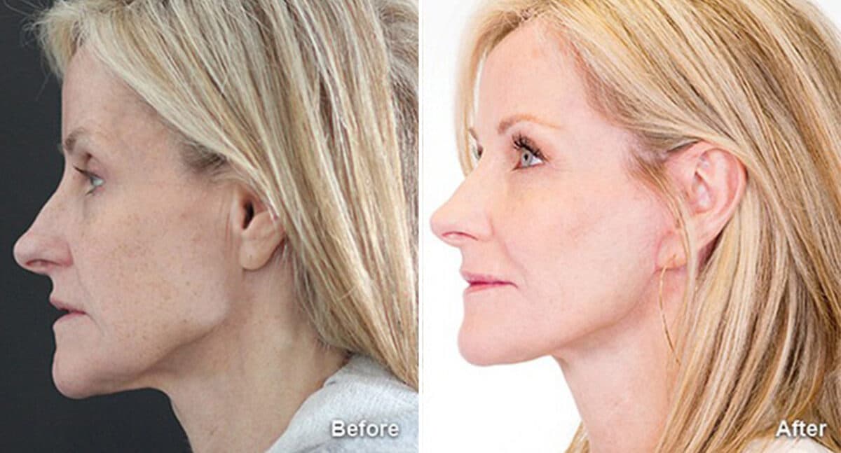 Facelift Before and After Photos in Princeton, NJ, Patient 190