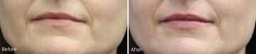 Lip Augmentation Before and After Photos in Princeton, NJ, Patient 1140