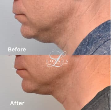 Liposuction Before and After Photos in Philadelphia, PA, Patient 1521