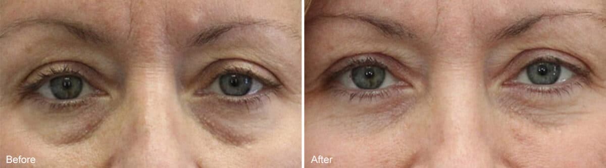 Lower Eyelid Surgery Before and After Photos in Princeton, NJ, Patient 1107