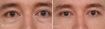 Lower Eyelid Surgery Before and After Photos in Princeton, NJ, Patient 1111