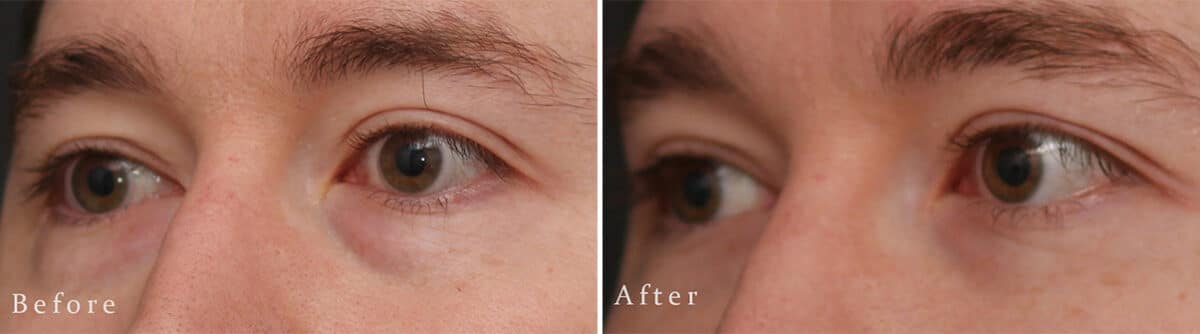 Lower Eyelid Surgery Before and After Photos in Princeton, NJ, Patient 1111