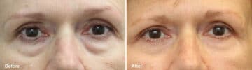 Lower Eyelid Surgery Before and After Photos in Princeton, NJ, Patient 1103