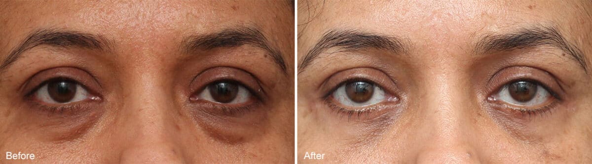 Lower Eyelid Surgery Before and After Photos in Princeton, NJ, Patient 1118