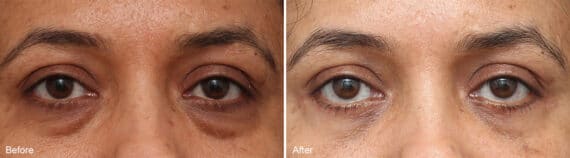 Lower Eyelid Surgery Before and After Photos in Princeton, NJ, Patient 1118
