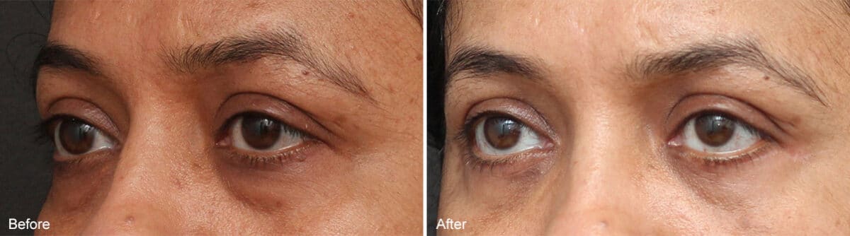 Lower Eyelid Surgery Before and After Photos in Princeton, NJ, Patient 1118