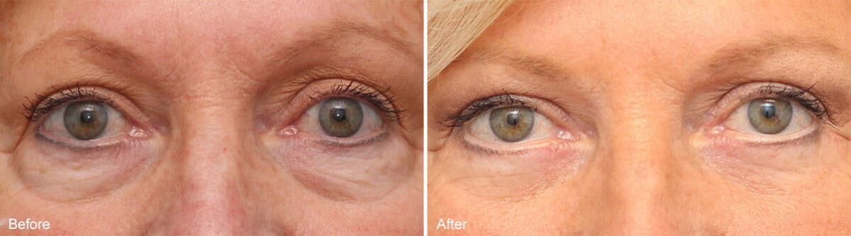 Lower Eyelid Surgery Before and After Photos in Princeton, NJ, Patient 1128